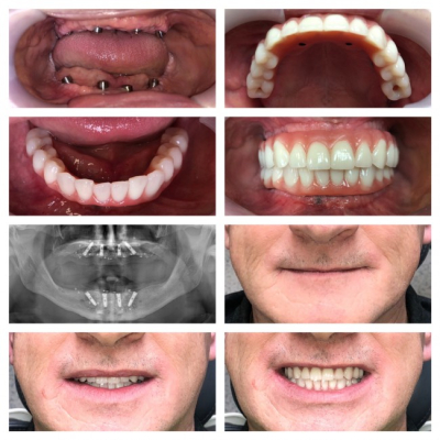 Se zubními implantáty se opět budete bez obav usmívat